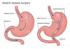 Gastric Bypass And Gastric Band Stock Photography CartoonDealer 