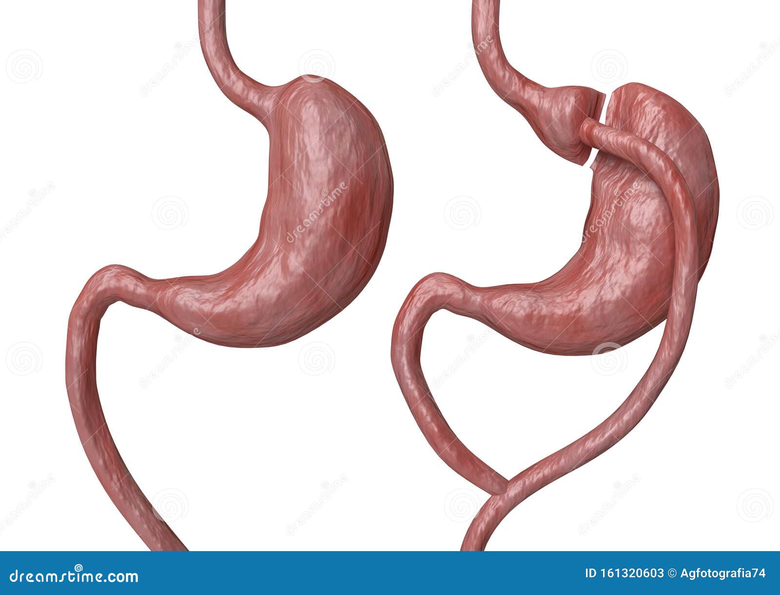 Gastric Bypass And Gastric Band Stock Image CartoonDealer 82452793 gastric-bypass-and-gastric-band-stock-image-cartoondealer-82452793