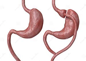 Gastric Bypass And Gastric Band Stock Image CartoonDealer 82452793