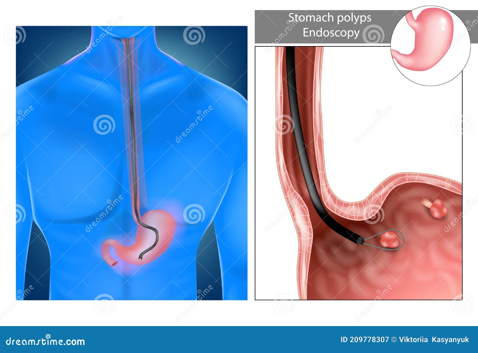 Removal Of Stomach Polyps RoyaltyFree Stock Photography