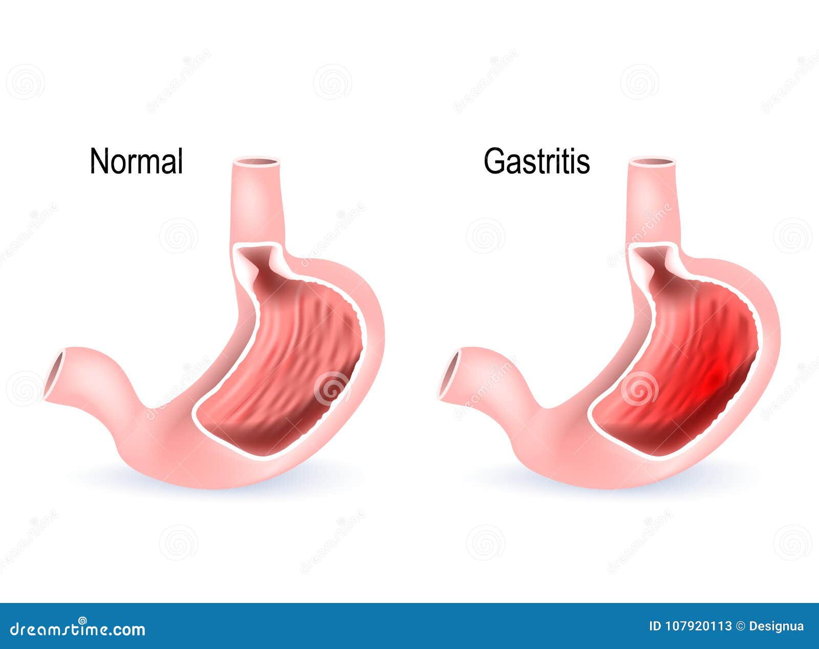 Gastritis Corte Transversal Del Estómago Dos Ilustración del Vector