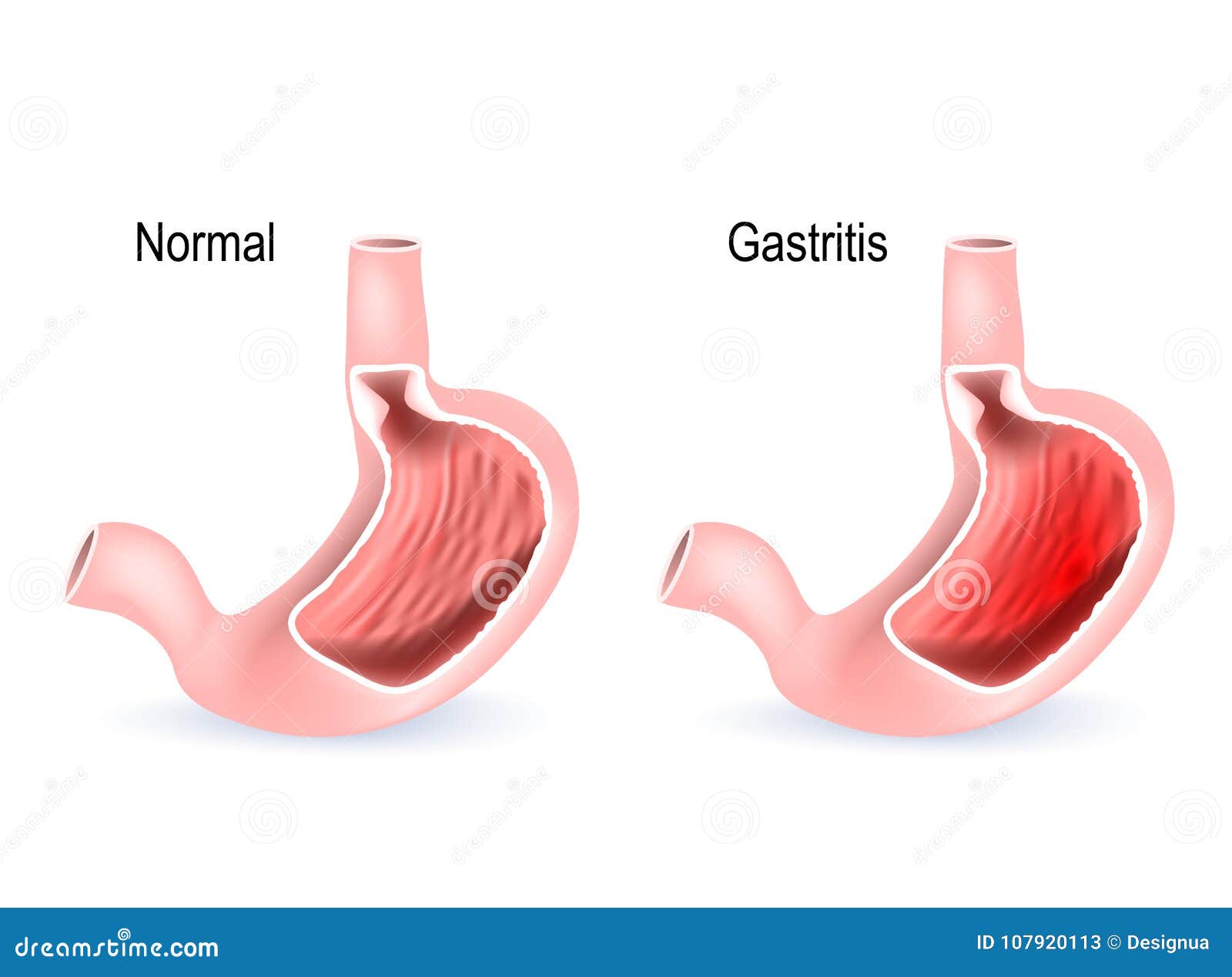 gastritis. cross section of two stomach