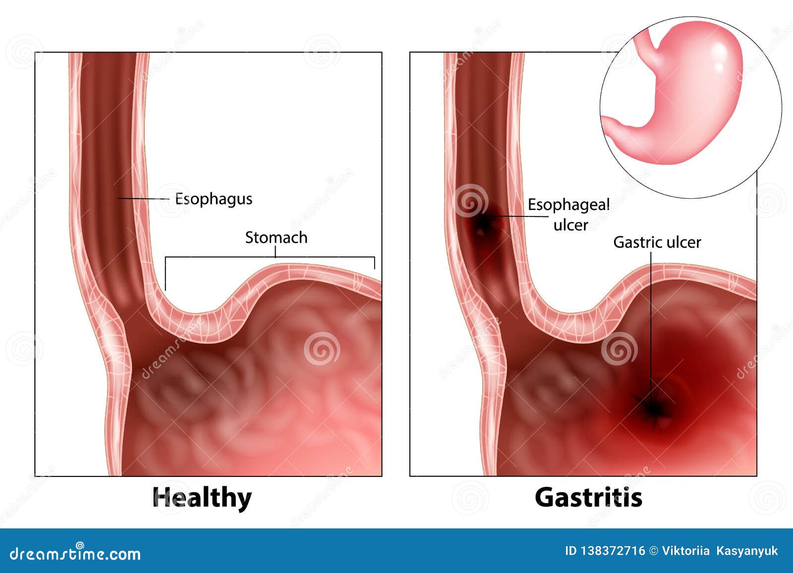 gastritis and esophageal ulcer