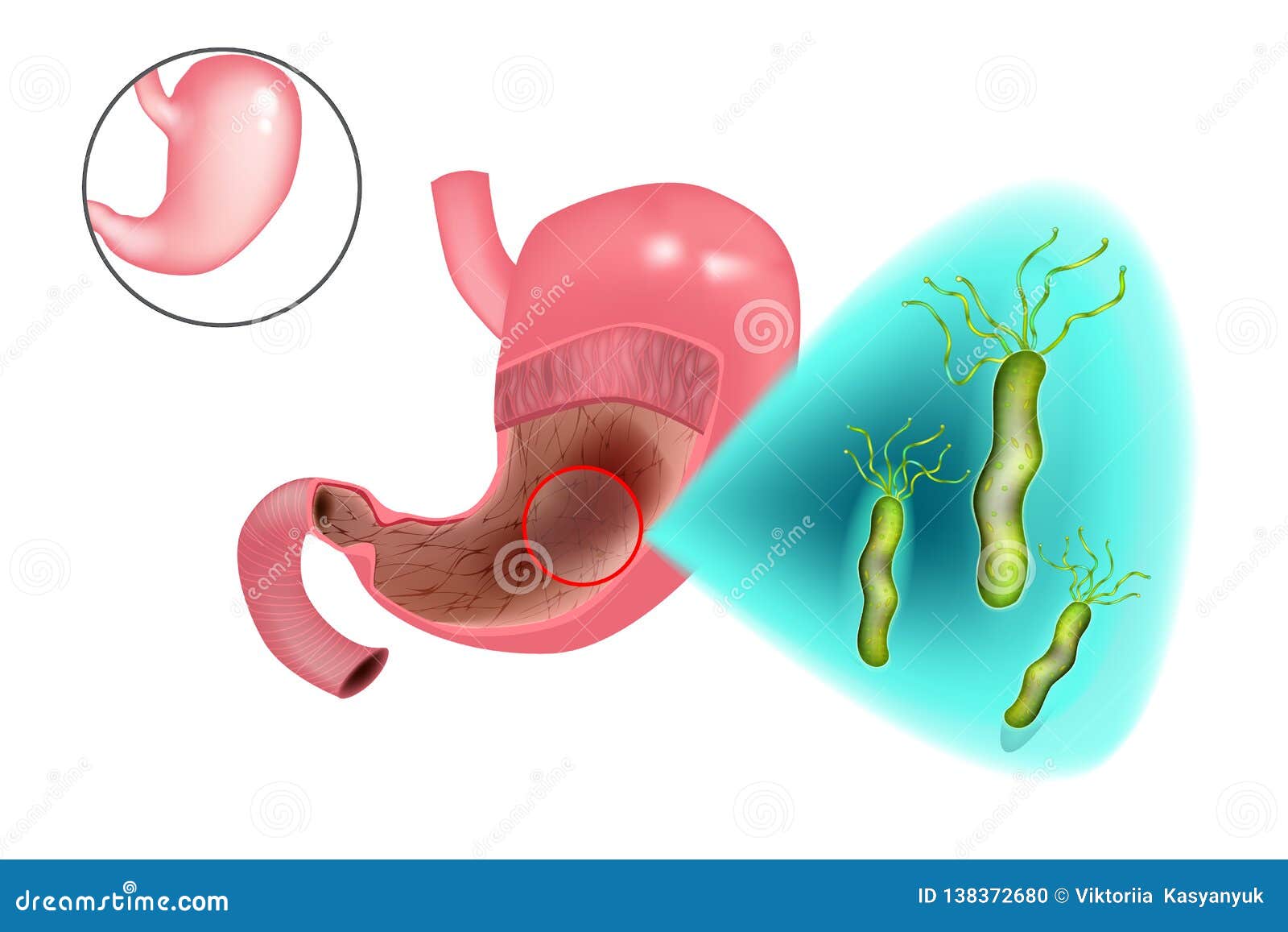 gastritis helicobacter pylori