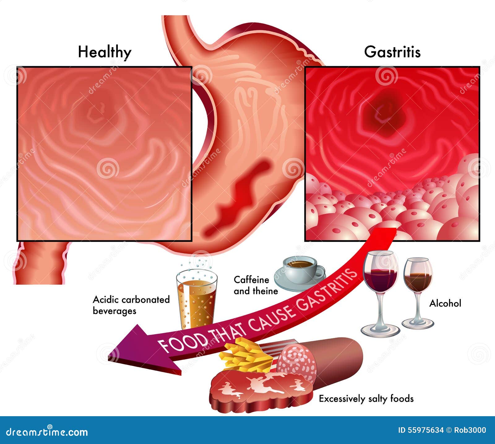 gastritis