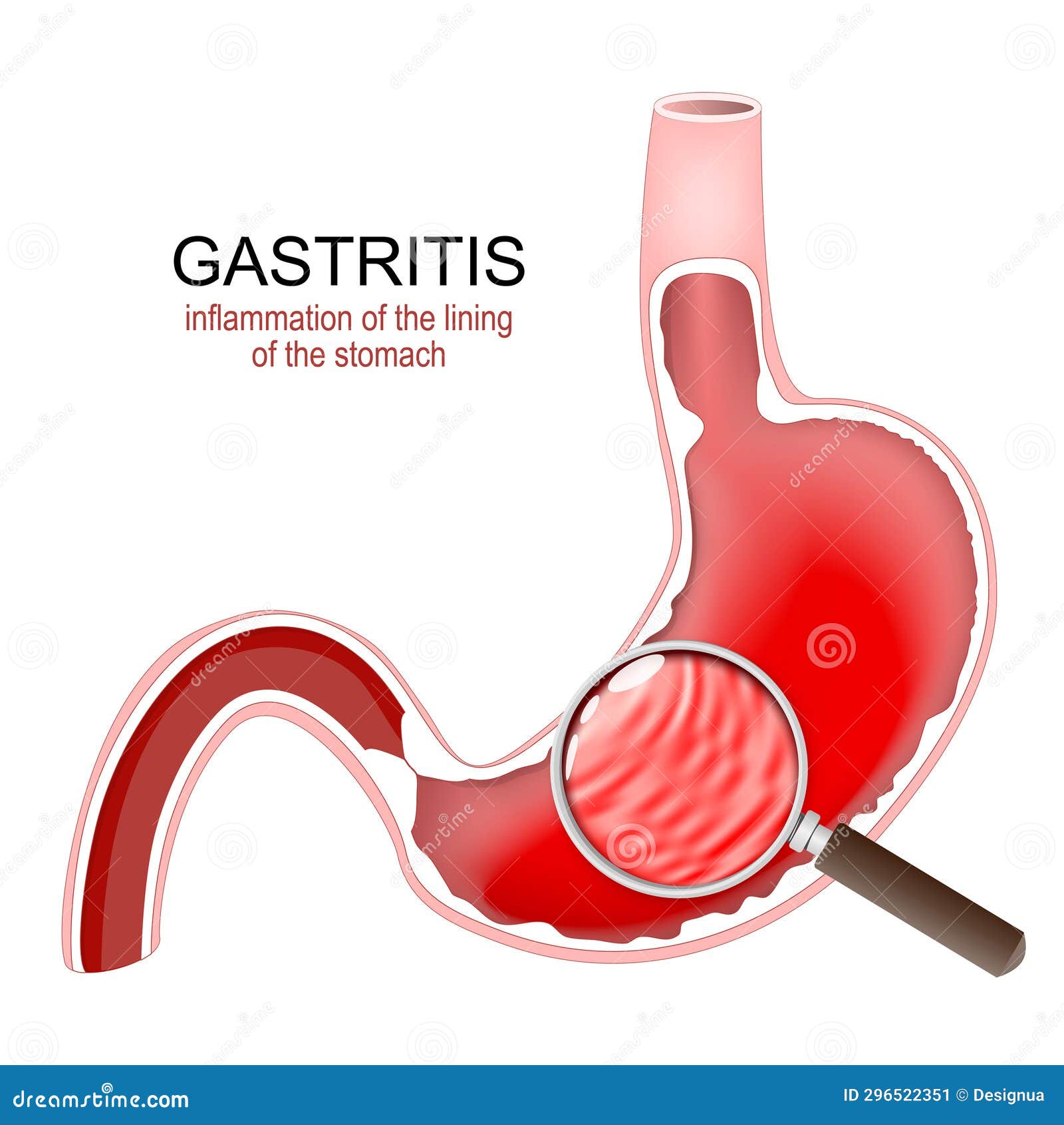 gastritis. stomach inflammation