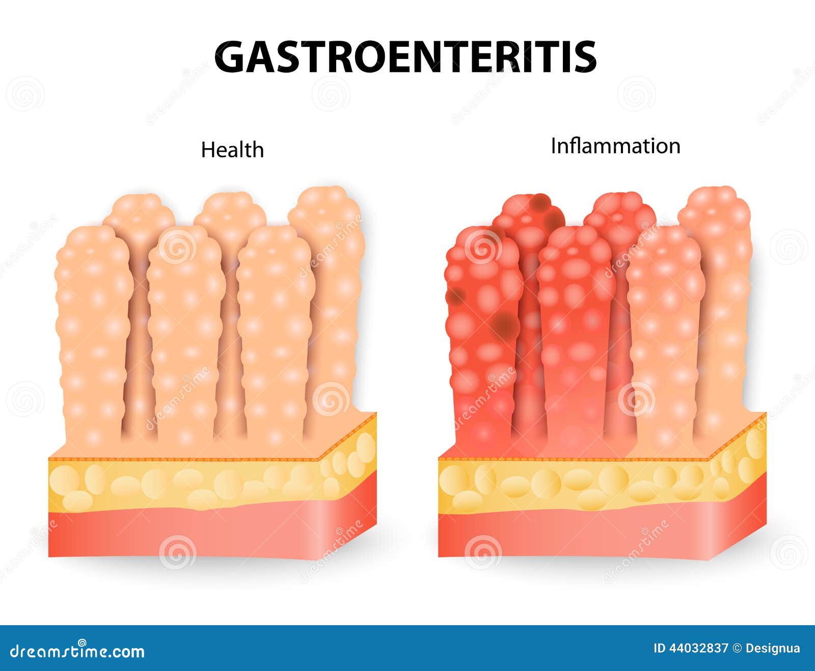 gastroenteritis or infectious diarrhea