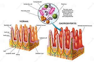 Gastroenteritis Vector Illustration CartoonDealer 72963888