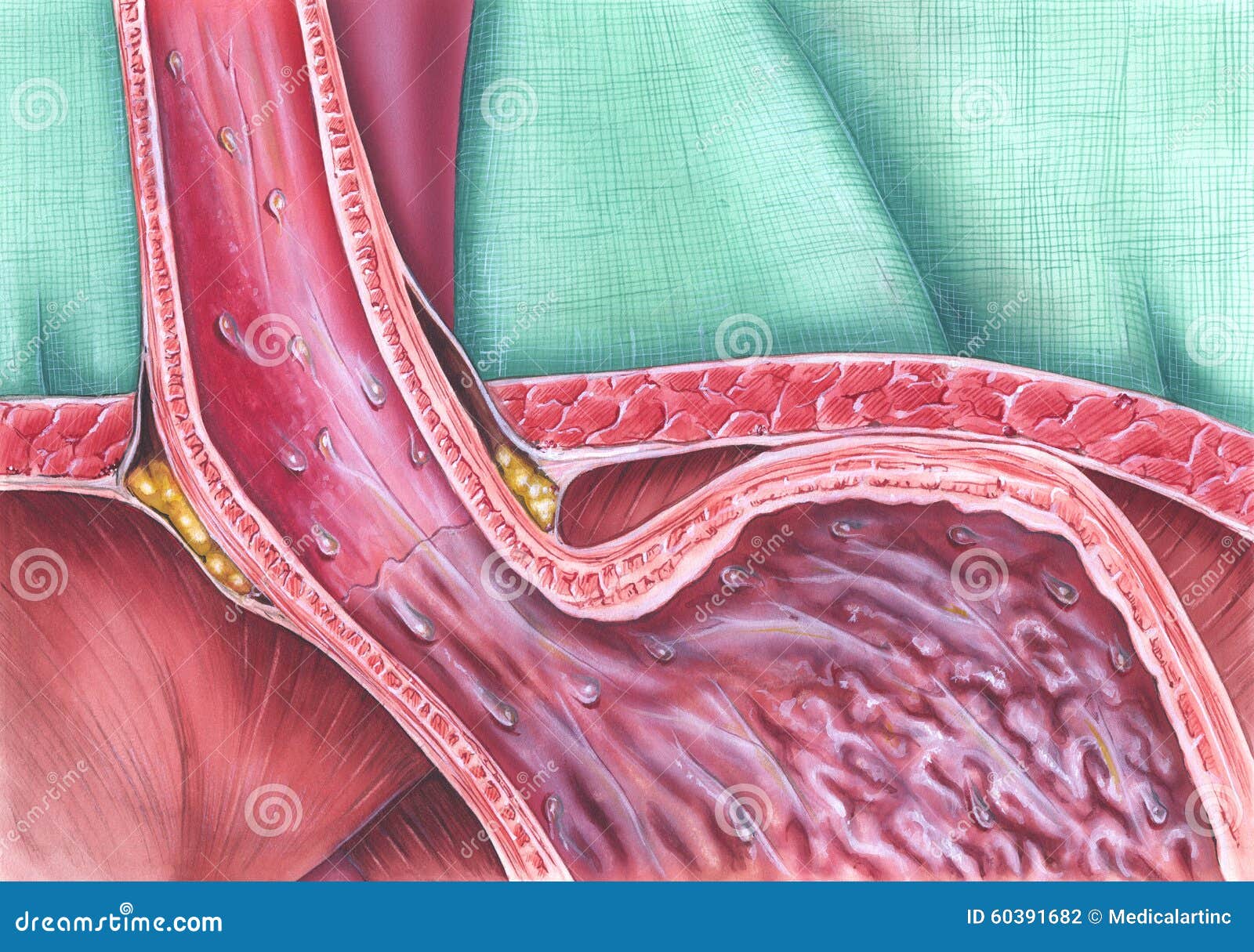 Gastroesophageal Reflux Disease Stock Photo - Image: 60391682