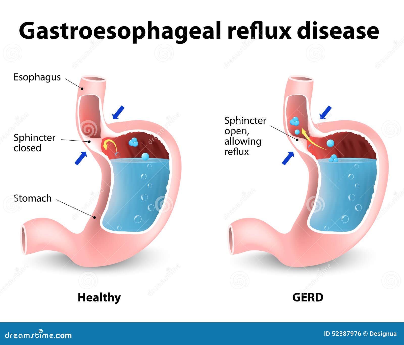 gastroesophageal reflux disease