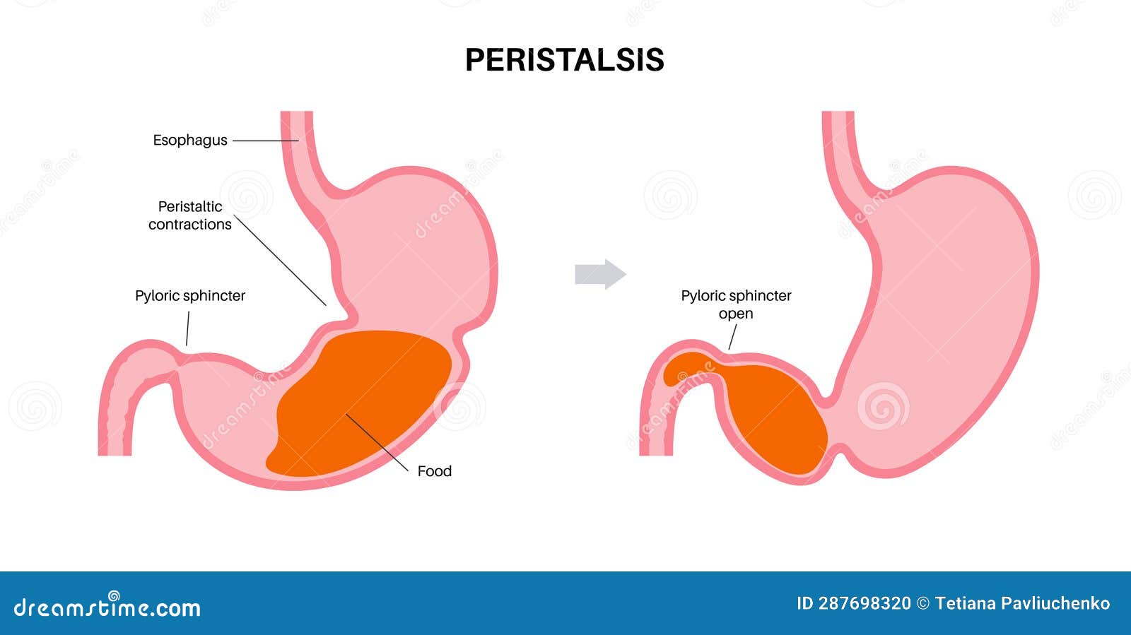 Gastroparesis Anatomical Poster Vector Illustration CartoonDealer gastroparesis-anatomical-poster-vector-illustration-cartoondealer