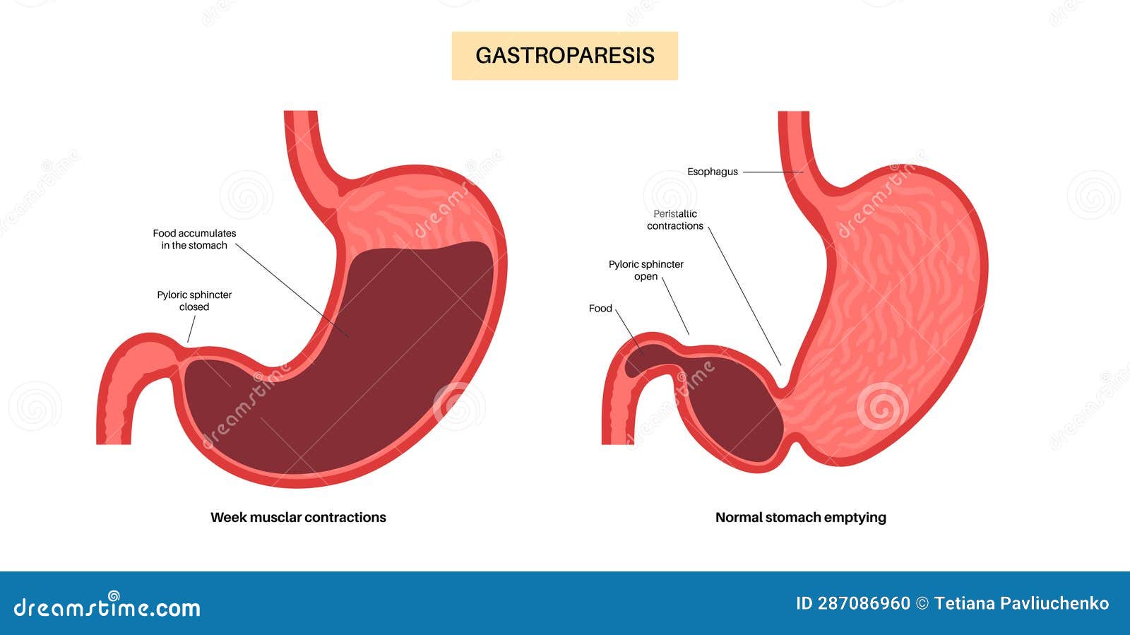 Gastroparesis Anatomical Poster Vector Illustration CartoonDealer gastroparesis-anatomical-poster-vector-illustration-cartoondealer