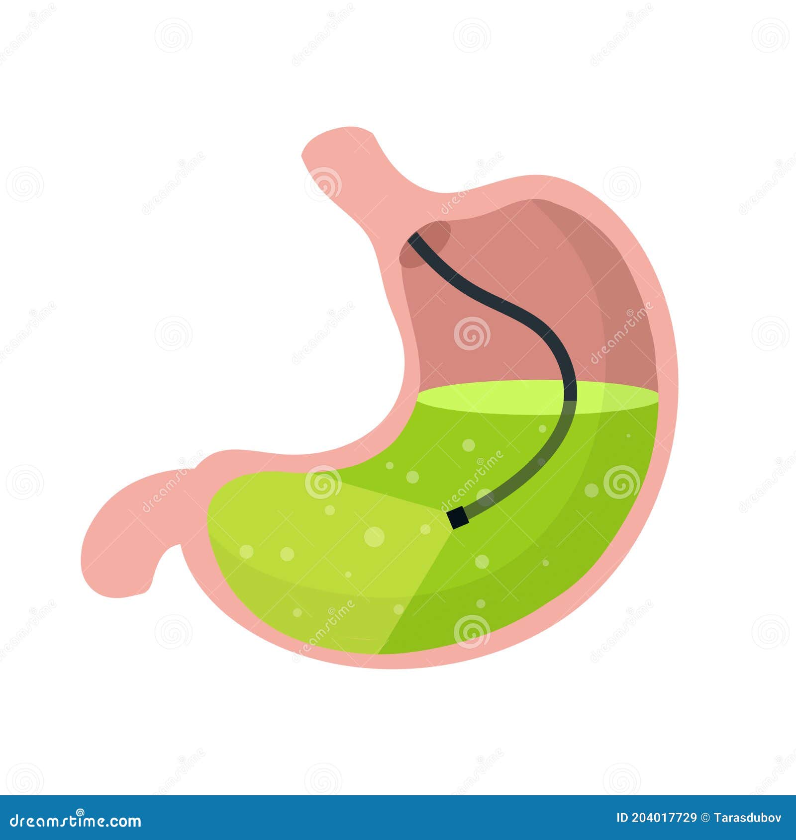 Gastroscopy. Endoscopy and Digestive Problems. Hose with Camera Stock