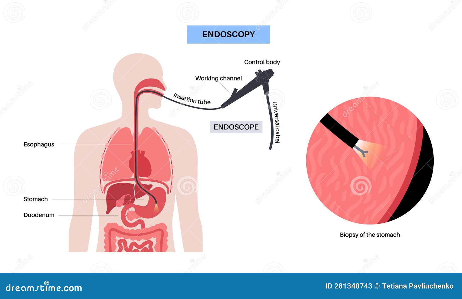 gastroscopy endoscopy procedure
