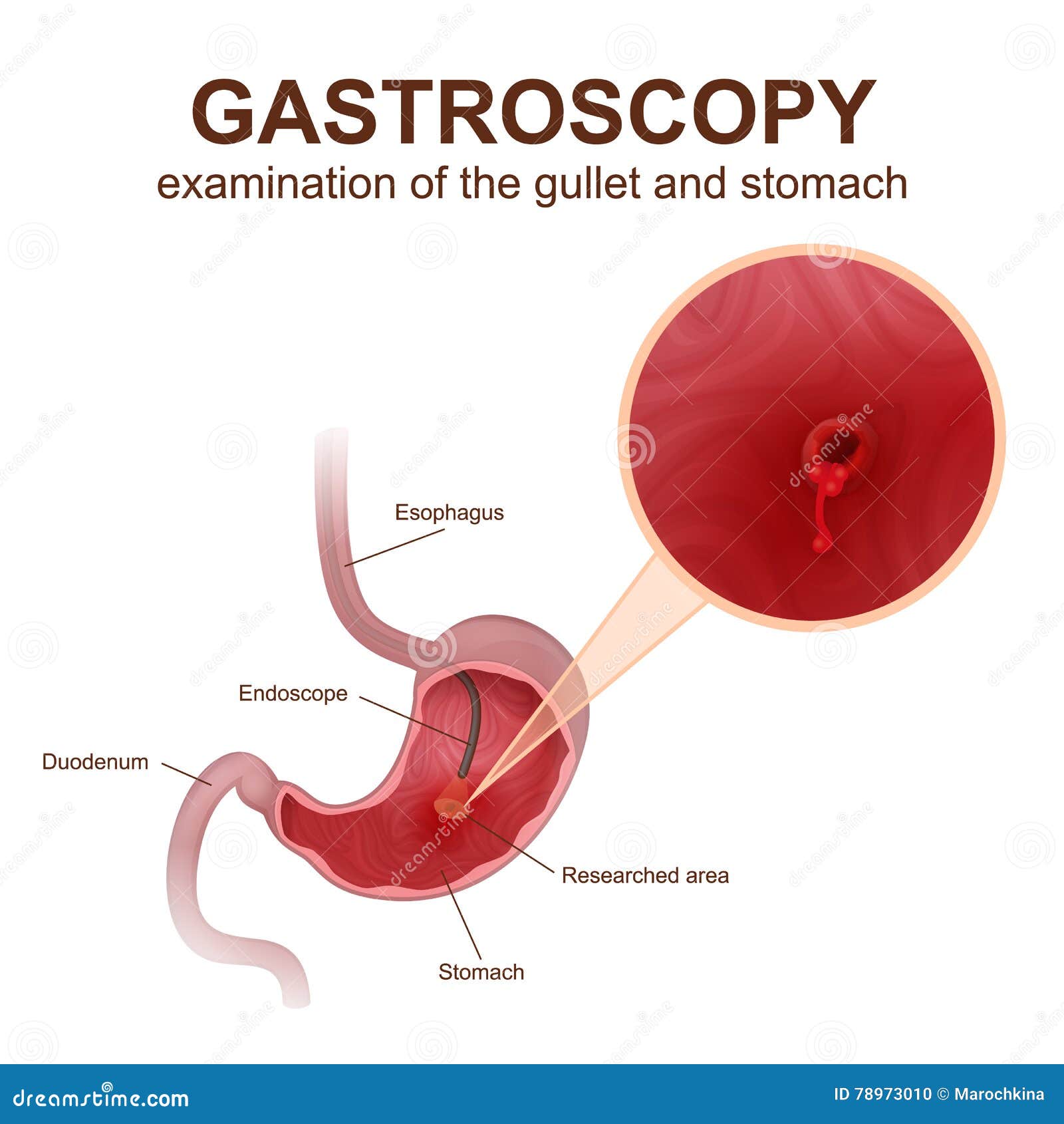 Gastroscopy Procedure. Human Stomach With Peptic Ulcer, And Endoscopic