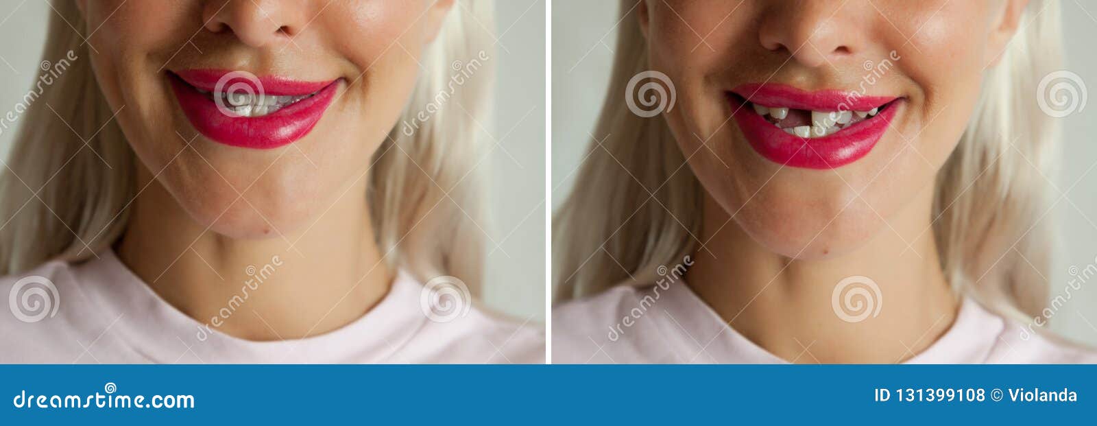 Gebrochener Zahn Und Zahnimplantat Vorher Und Nachher Stockfoto Bild Von Zahn Gebrochener