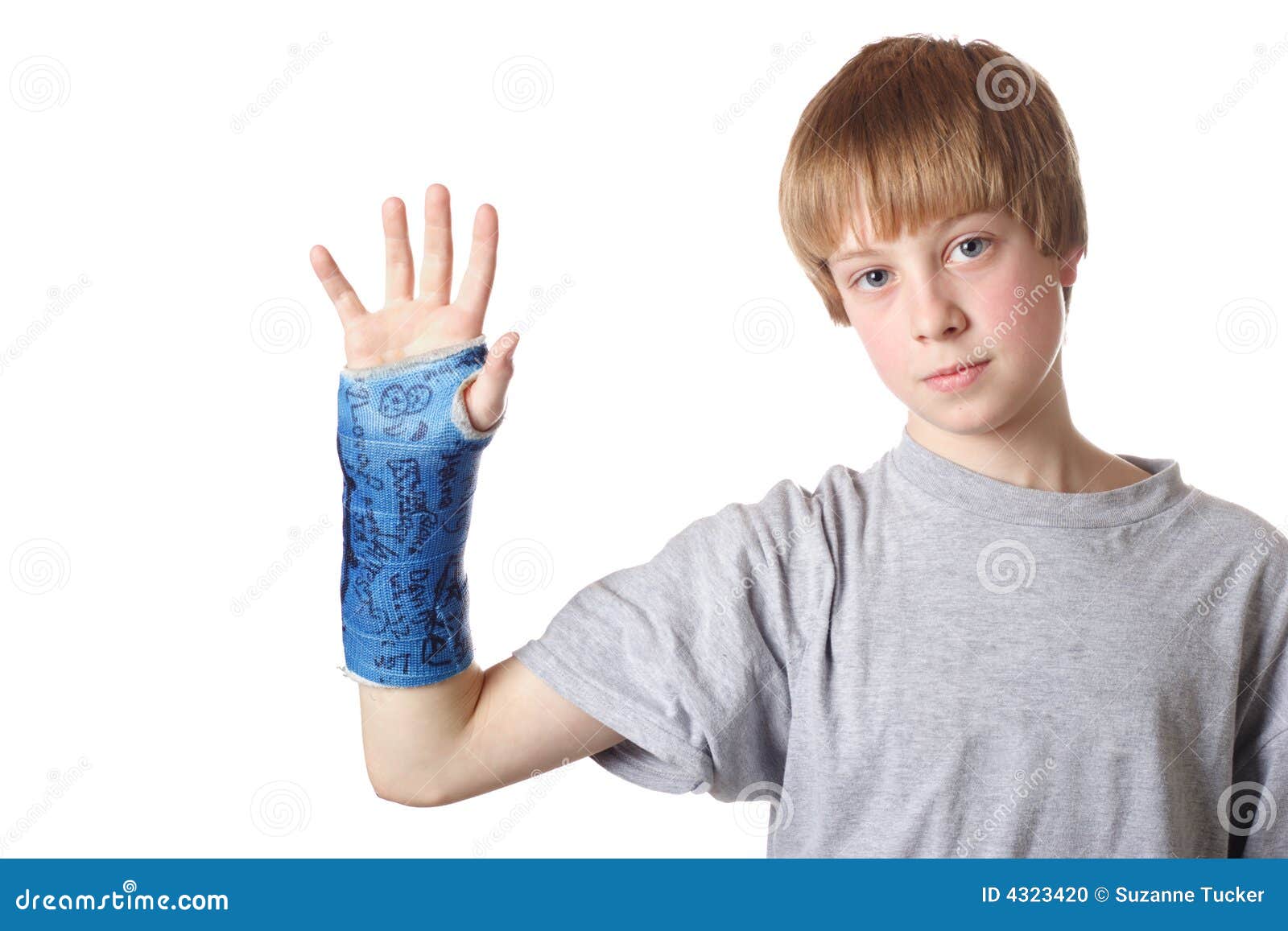 Gebrochenes Handgelenk. Teenager halten seinen Arm, der seine Form zeigt