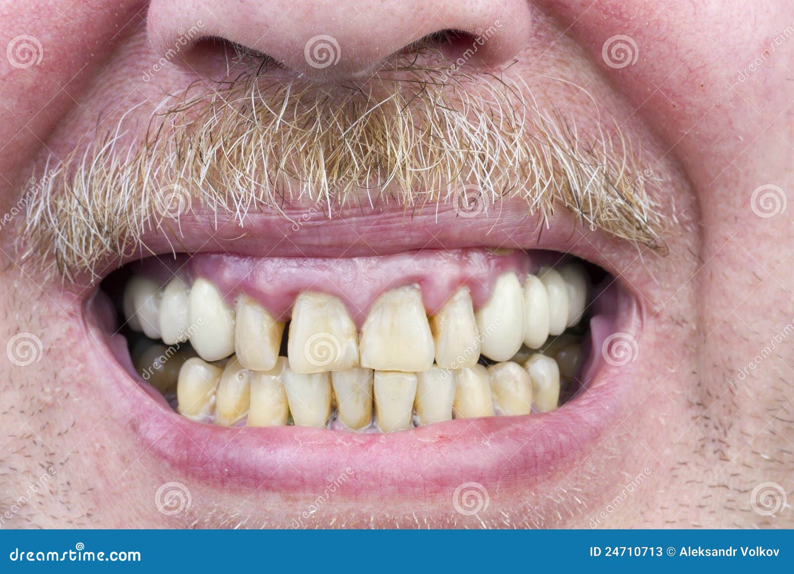 Gelbe zähne haben rothaarige warum Zahnstein beim