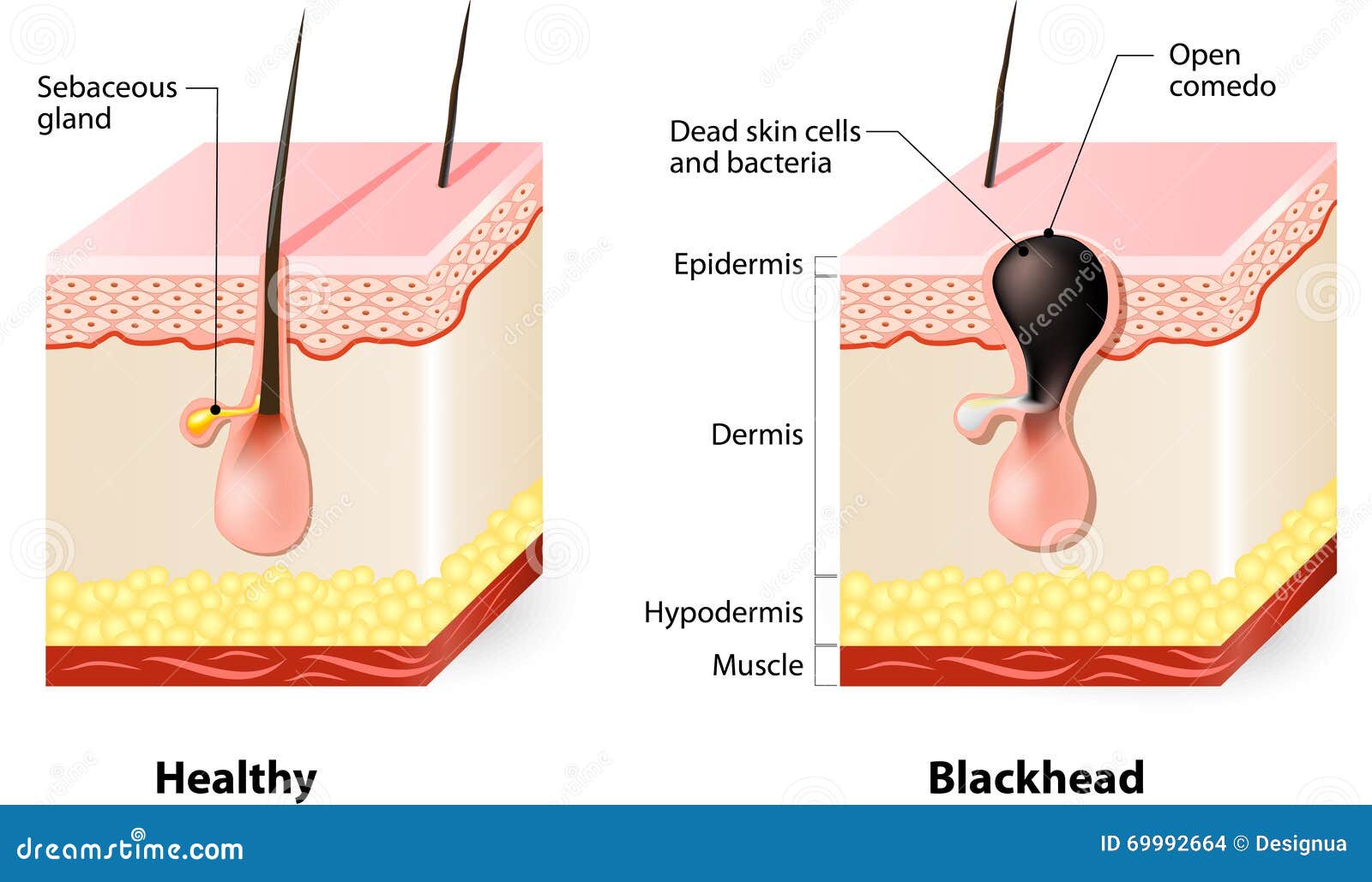 papules pictures #10