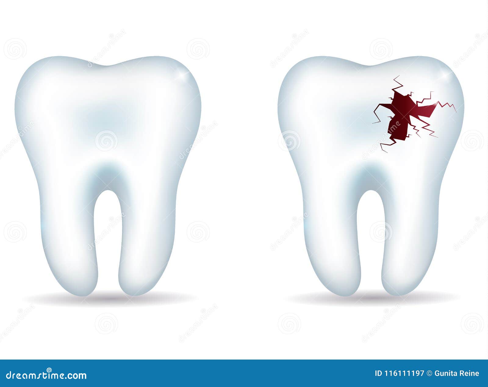 Gesunder Zahn Und Ungesunder Zahn Vektor Abbildung Illustration Von Anatomie Karies