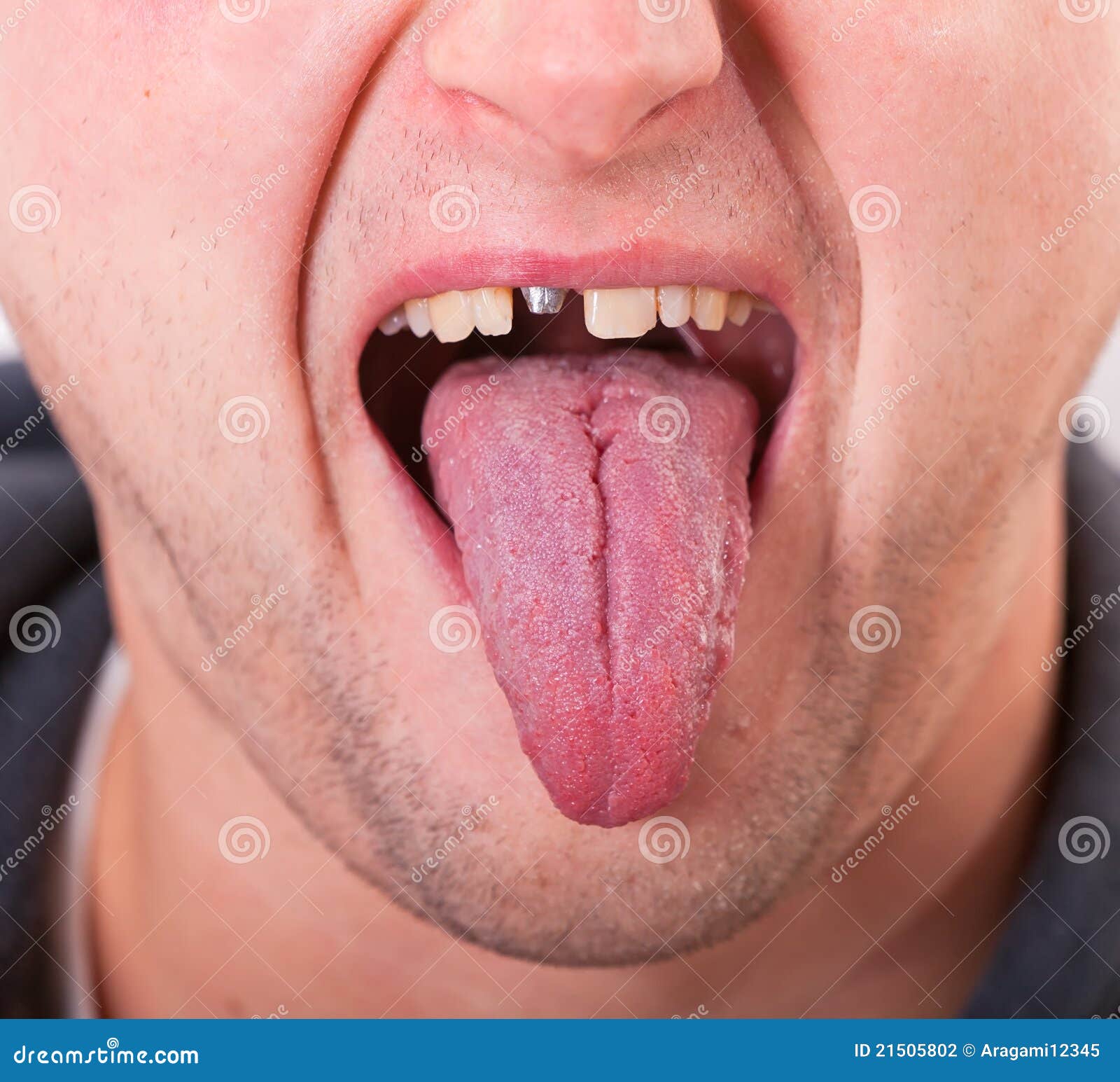 Gezicht Met Gebroken Tand En Tong Stock Foto Image of inspectie