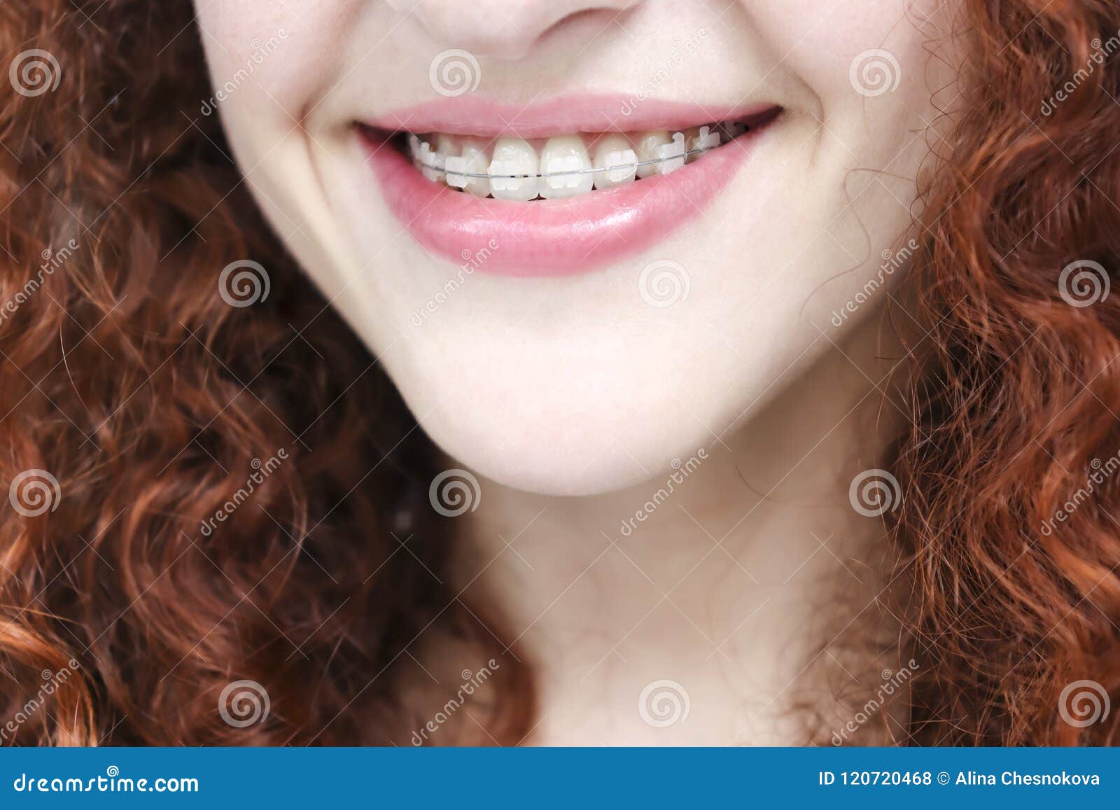 Redheads With Braces