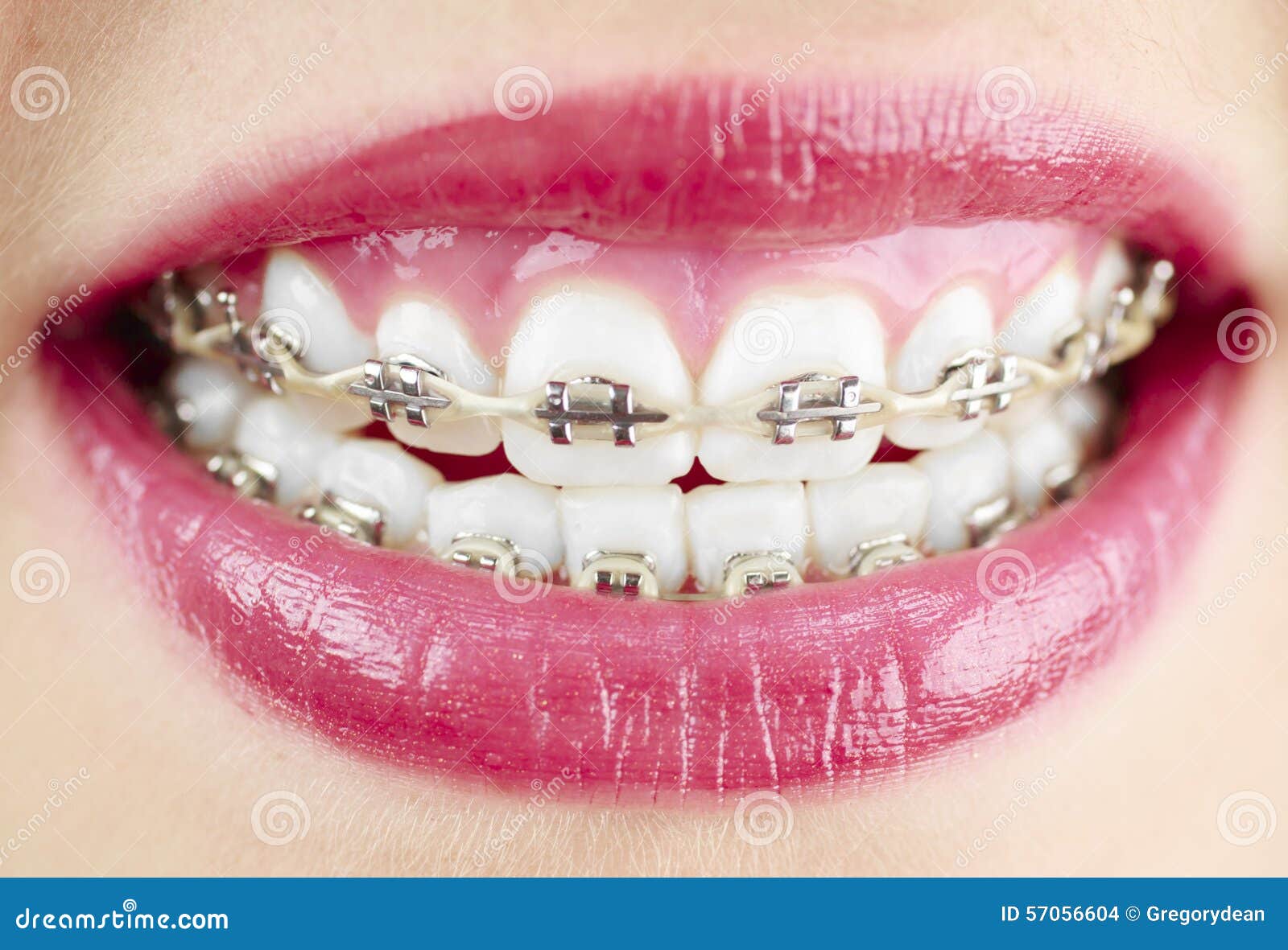 Girl with braces stock photo. Image of smile, pretty 57056604