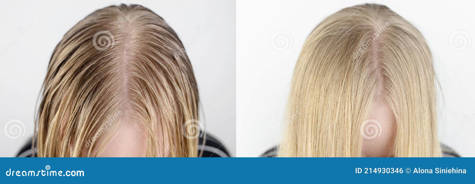 before and after. the girl looks in front of the mirror at her oily hair. problematic scalp and increased secretion of the