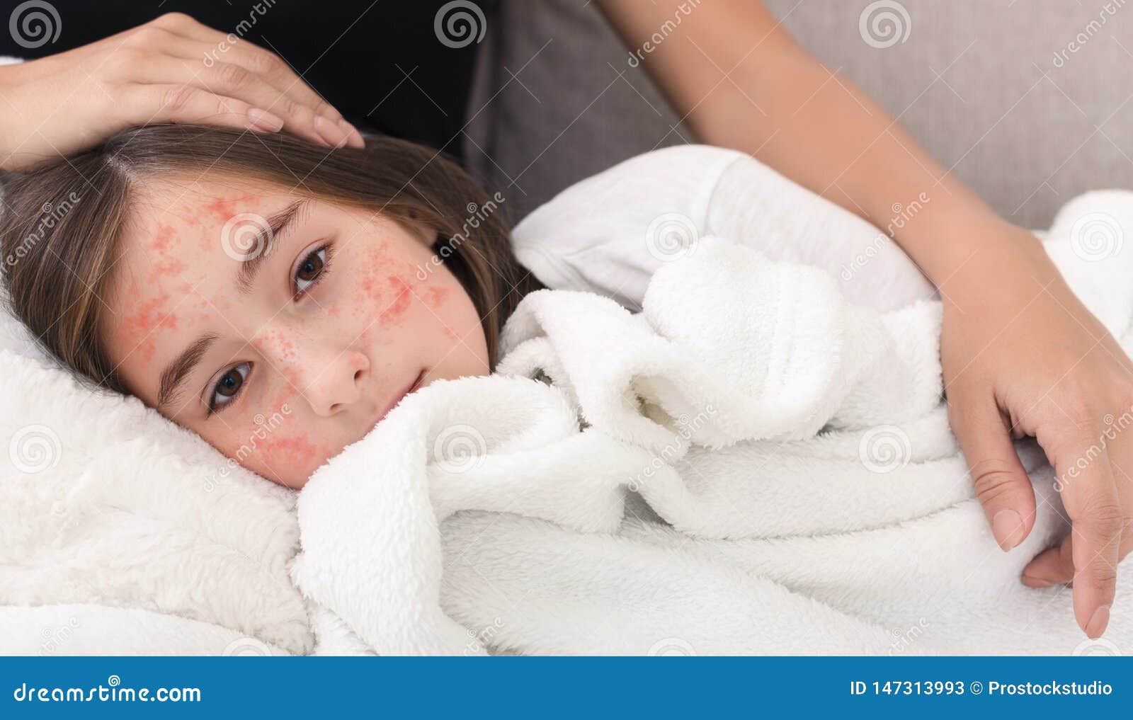 girl with measles virus lying on mother knees