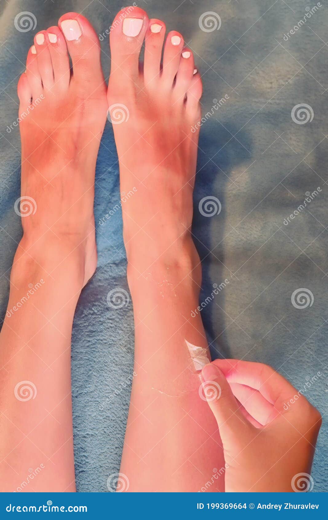 the girl peels off the skin off her legs after ultraviolet irradiation