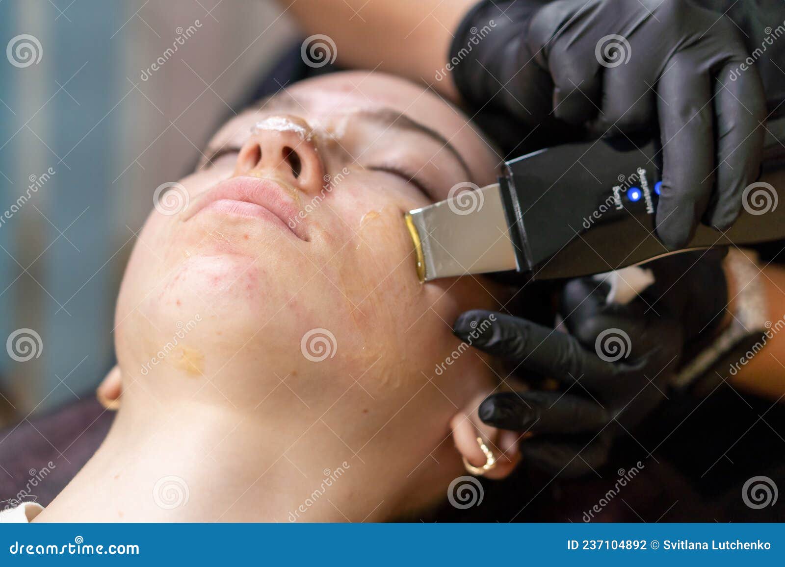 The Girl S Face During The Procedure Ultrasonic Cleaning Face Peeling