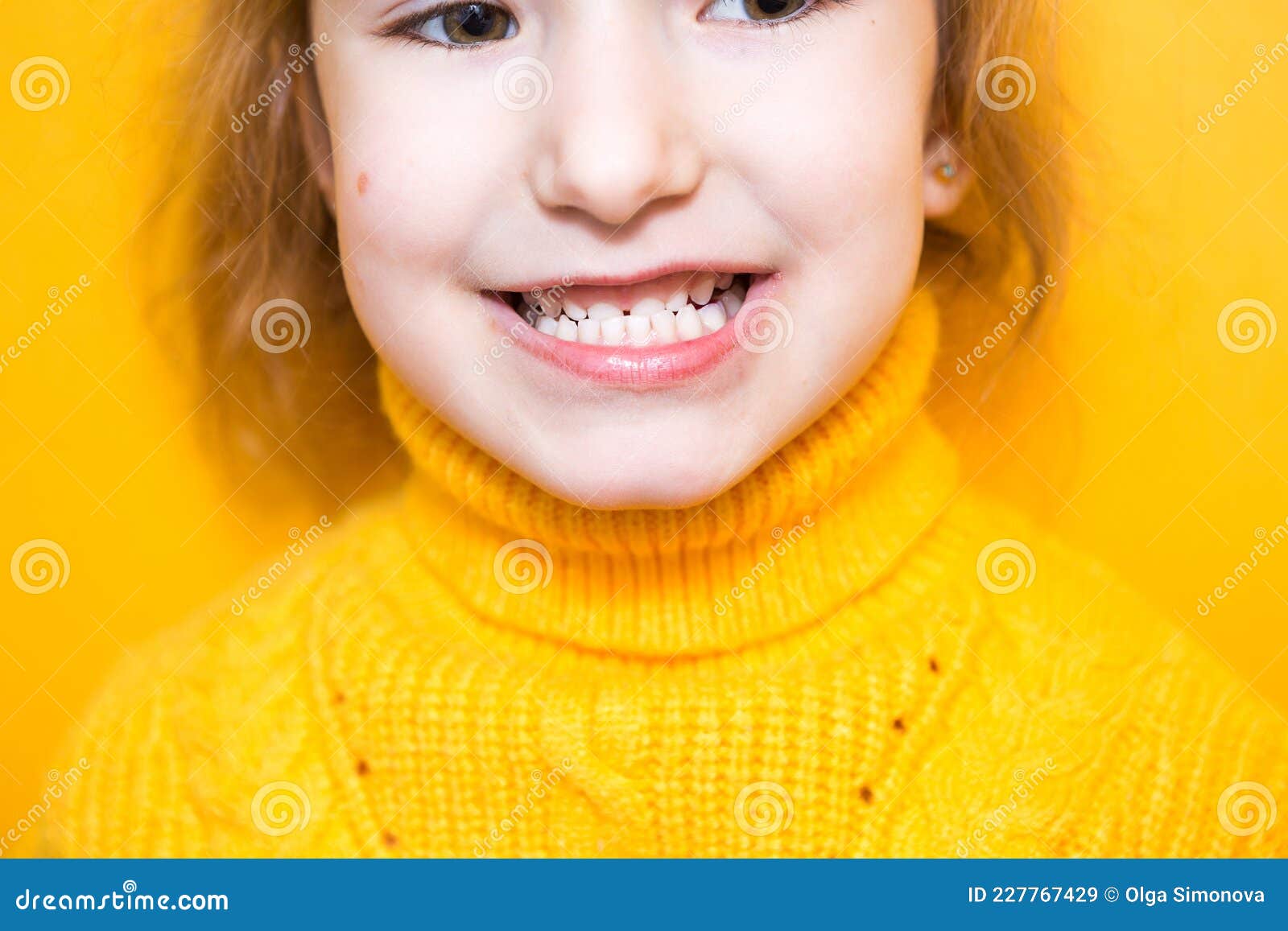 Girl Shows Her Teeth Pathological Bite Malocclusion Overbite 