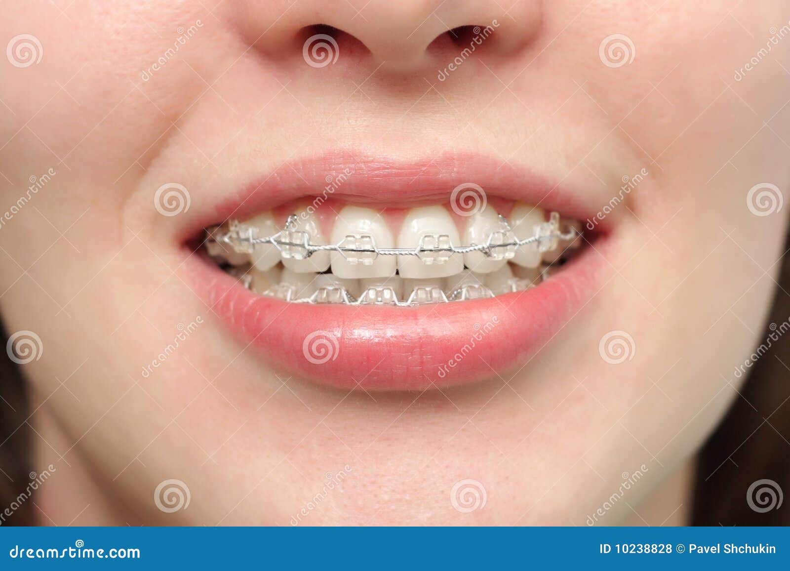 girl smiles with braces