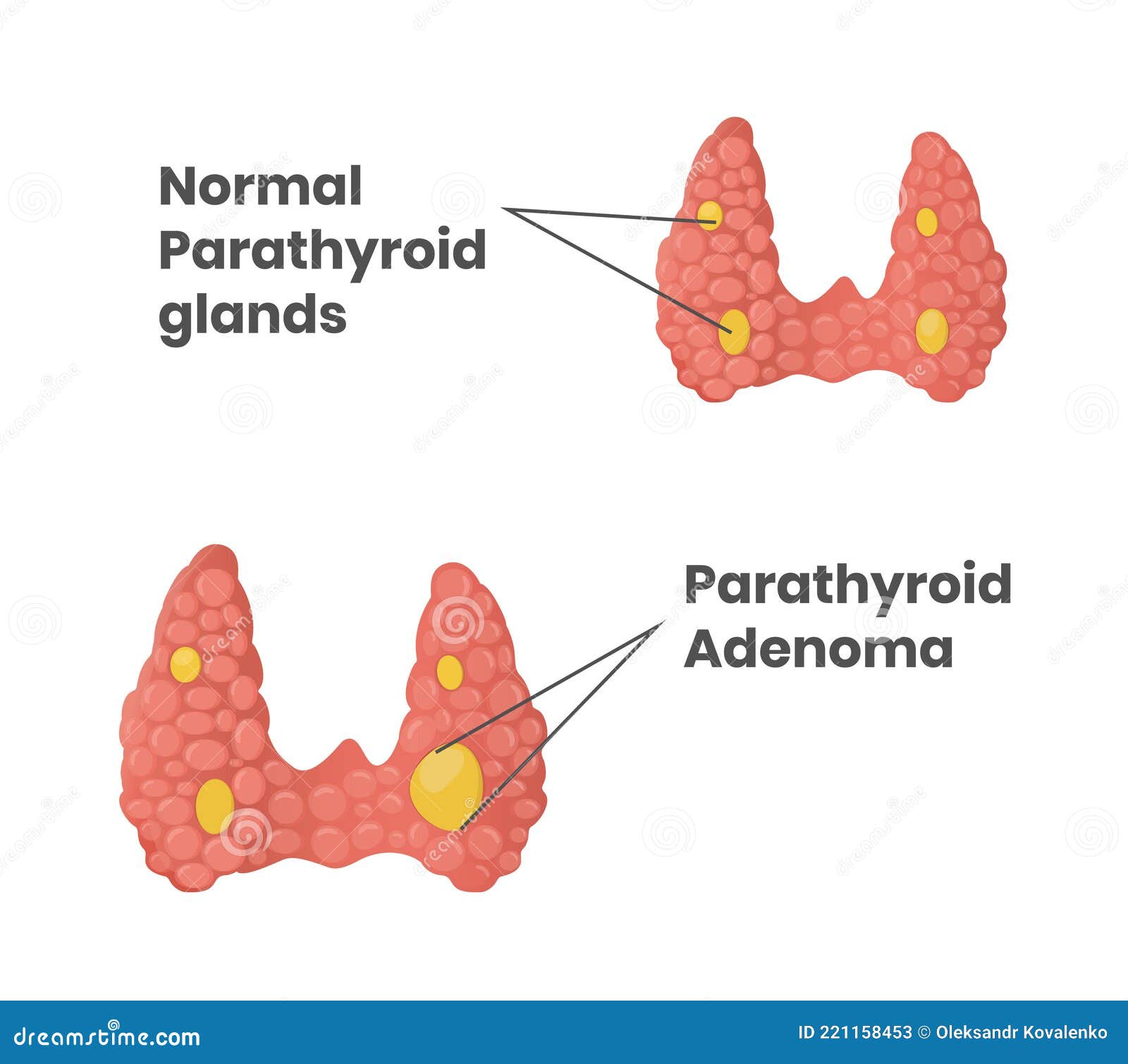 Glandes Parathyroïdes Normales Avec Adénome Parathyroïde ...