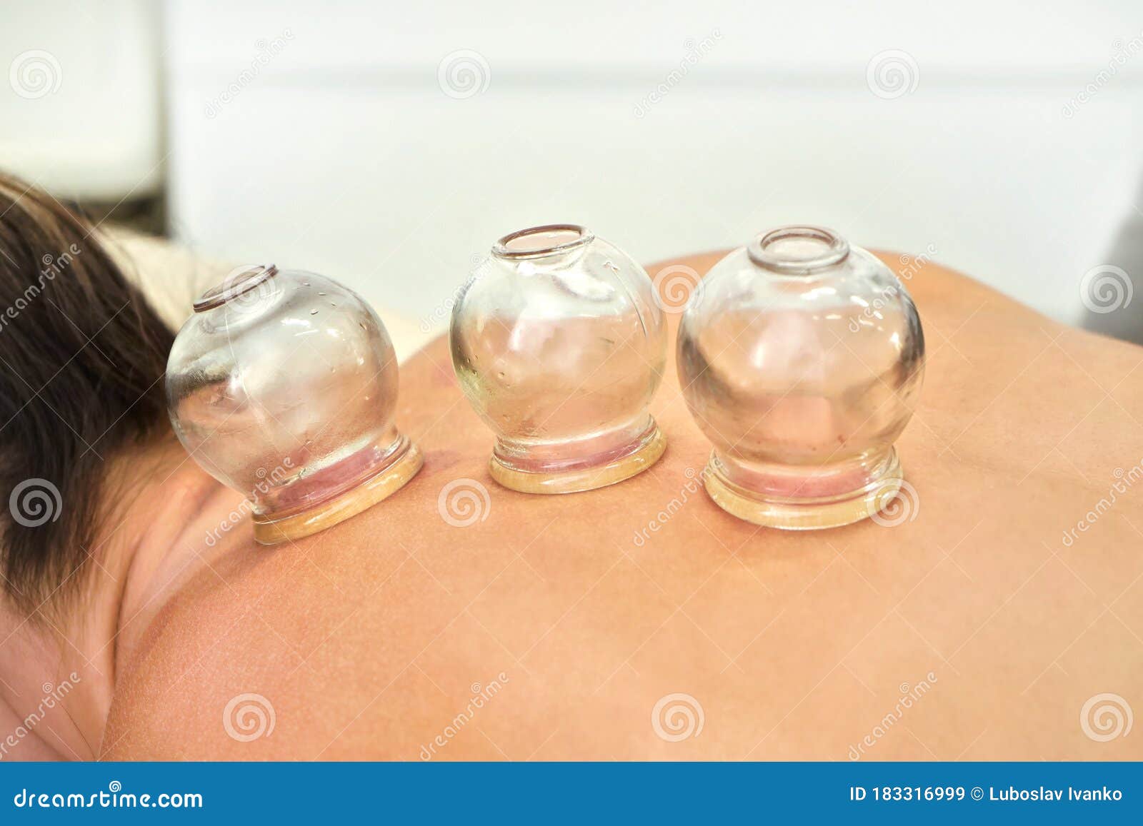 glass cups sucked on back of young woman - closeup detail of cupping therapy, alternative medicine form