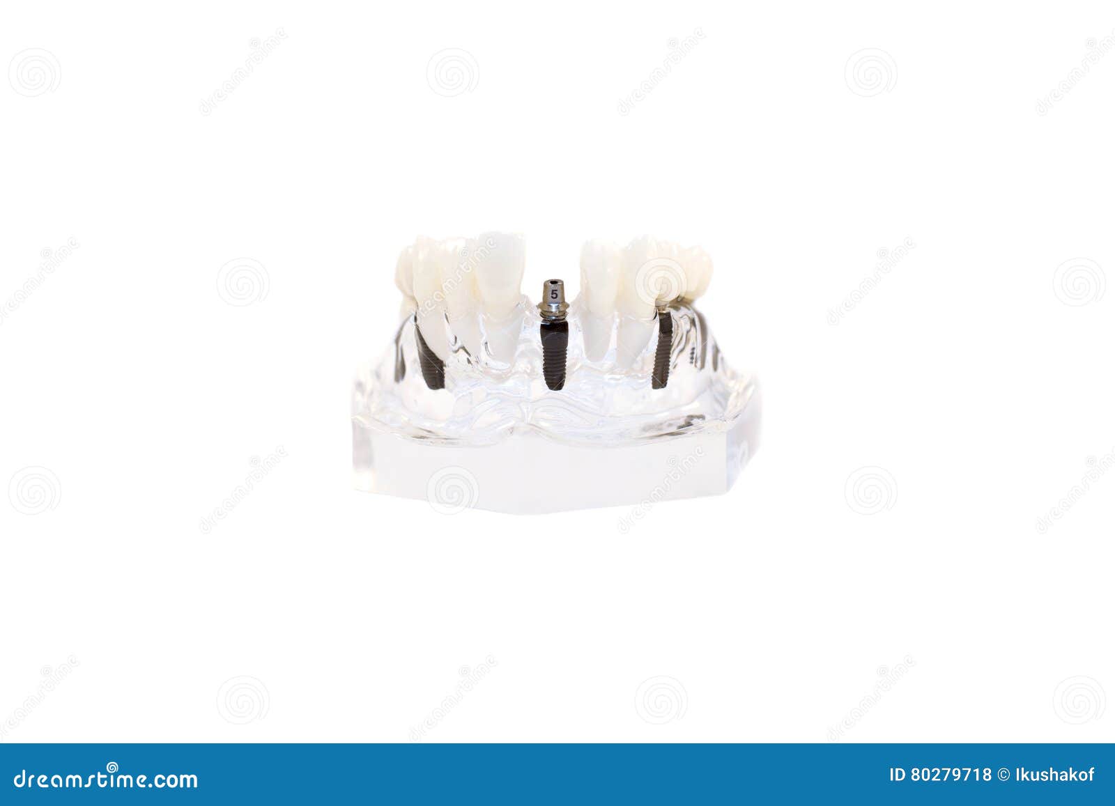 Glass Jaw Model with Implanted Dentures Stock Photo Image of implant, dimensional 80279718