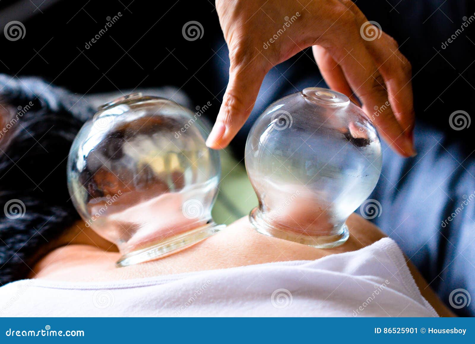 Glassfire Cupping Of Traditional Chinese Medicine Stock Image Image glassfire-cupping-of-traditional-chinese-medicine-stock-image-image
