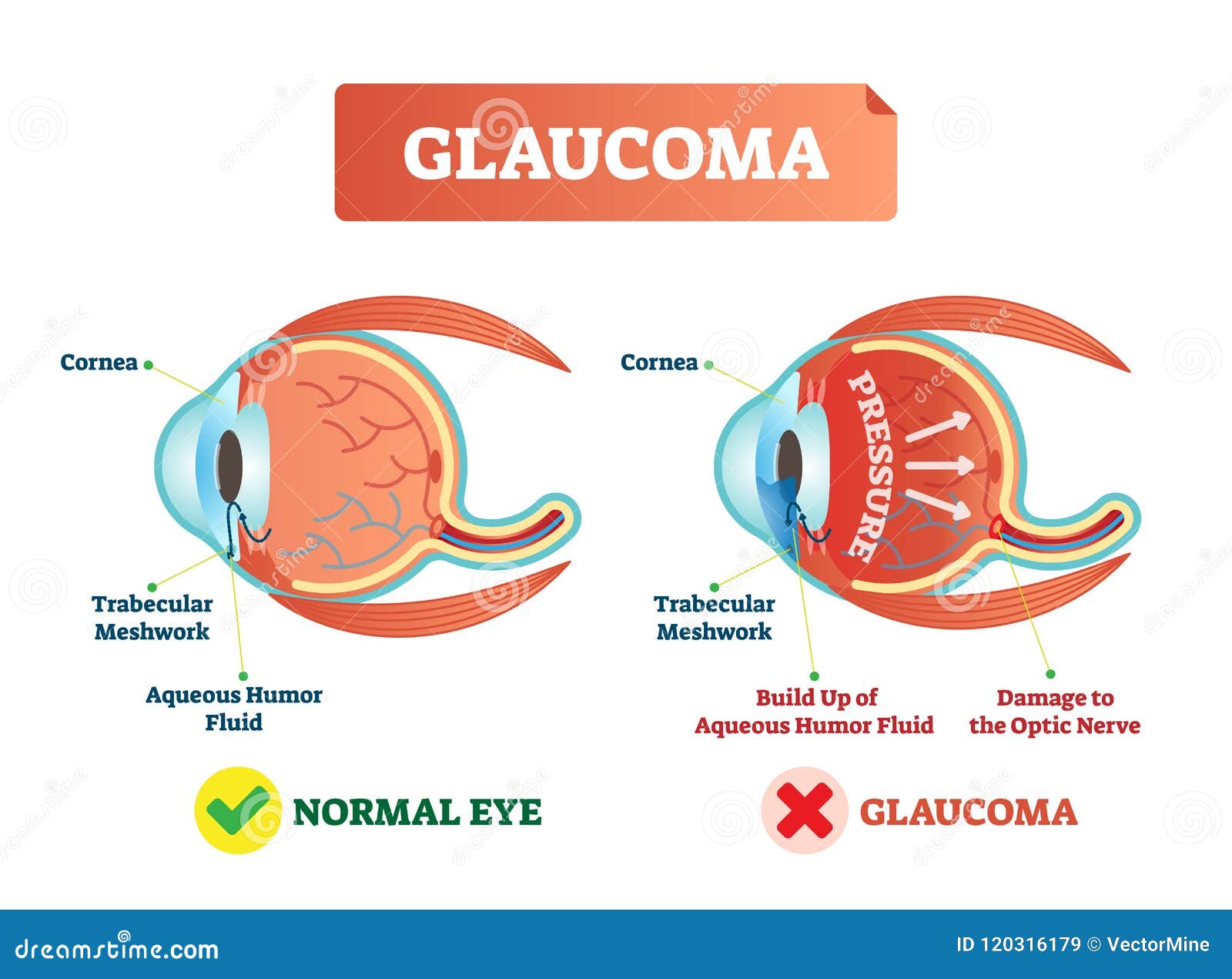   of glaucom. cross section with damaged eye. scheme with cornea, trabecular meshwork and aqueous humor fluid.
