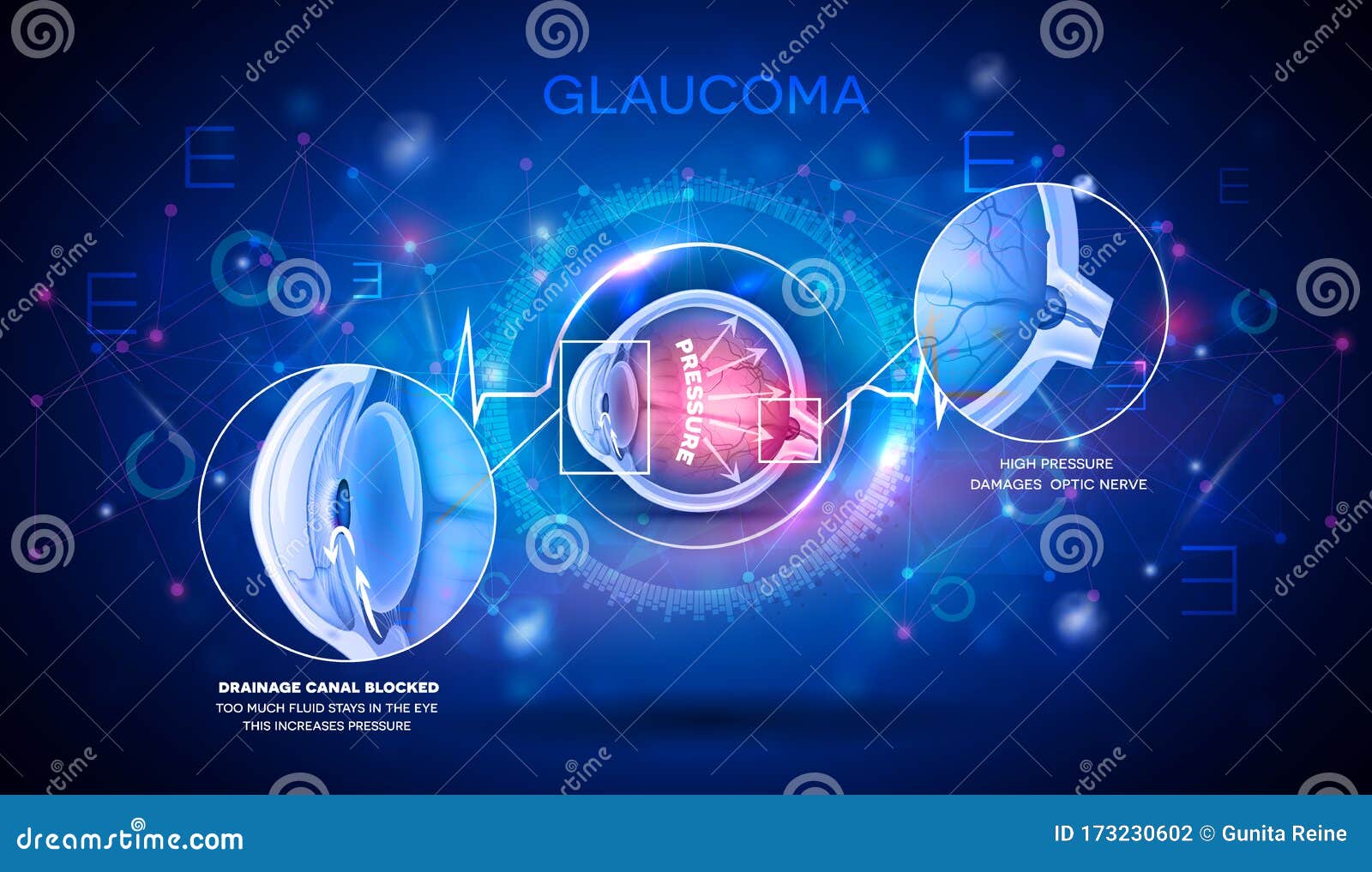 glaucoma