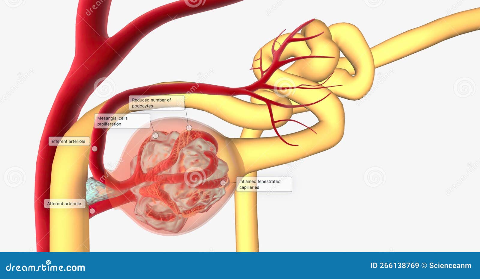 Glomerulonephritis is a Group of Renal Conditions Characterized by