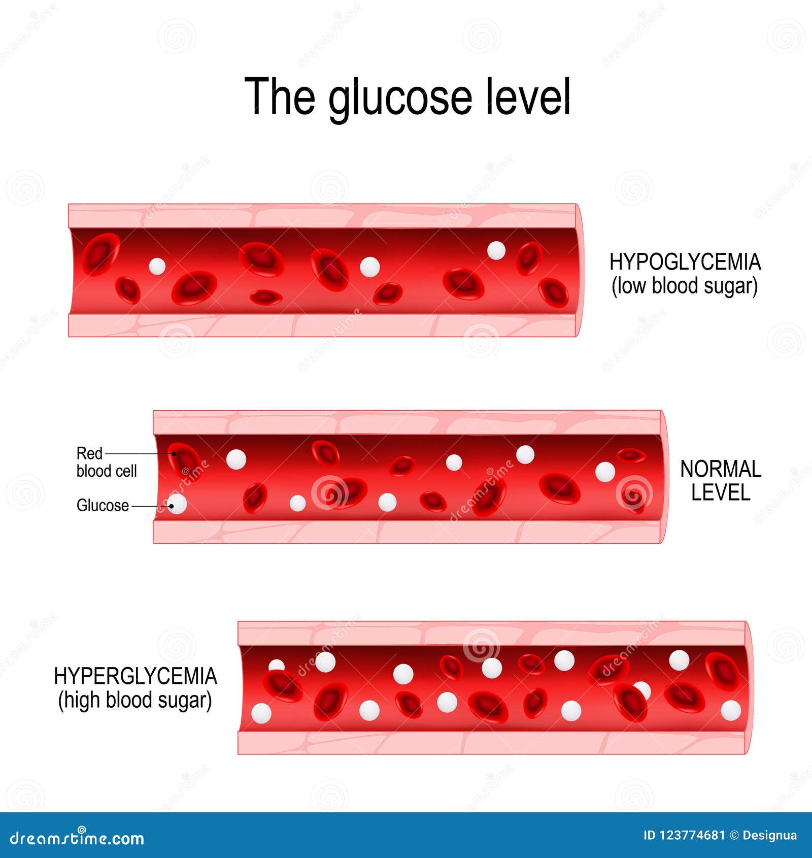 Blood Sugar Levels For Hyperglycemia Chart