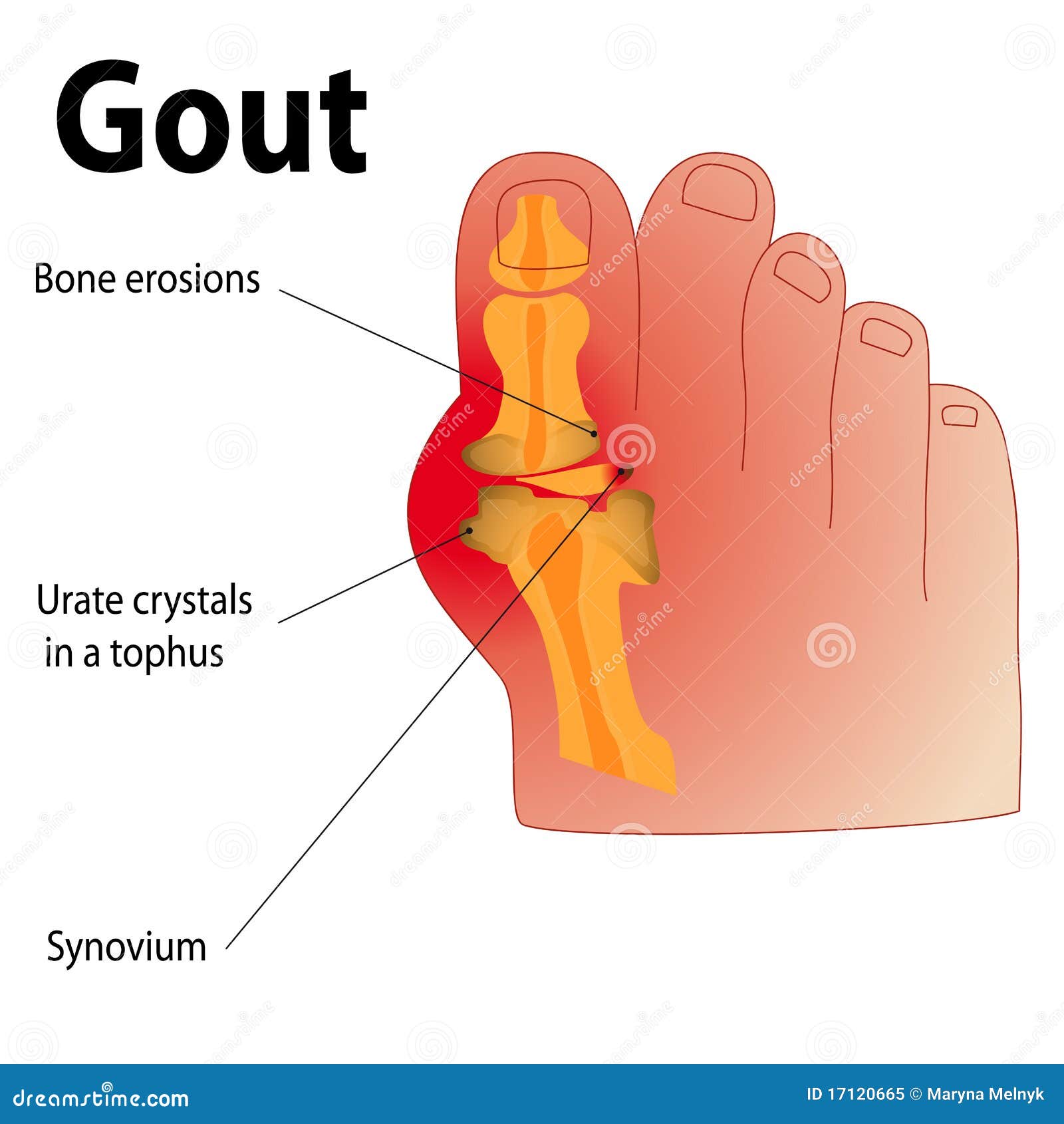 Gout stock vector. Illustration of shoes, toes, urate 17120665
