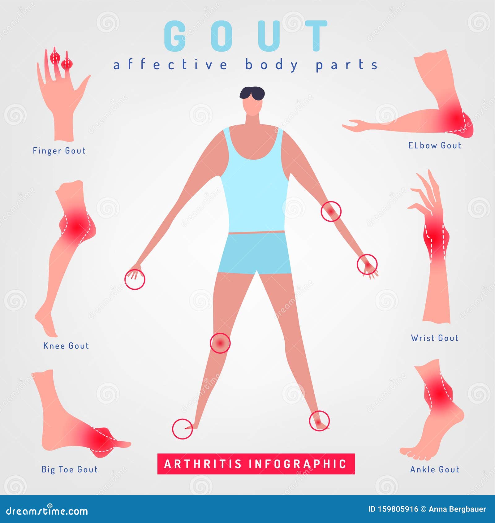 gout arthritis infographic