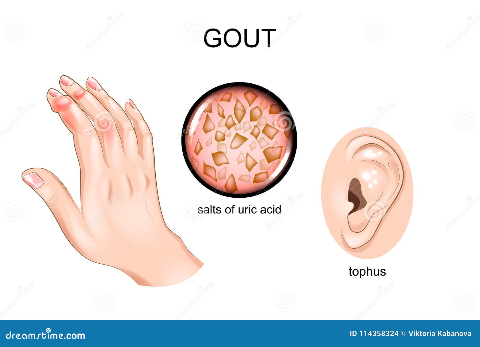 Gout, arthritis, tofus. stock vector. Illustration of acid 114358324