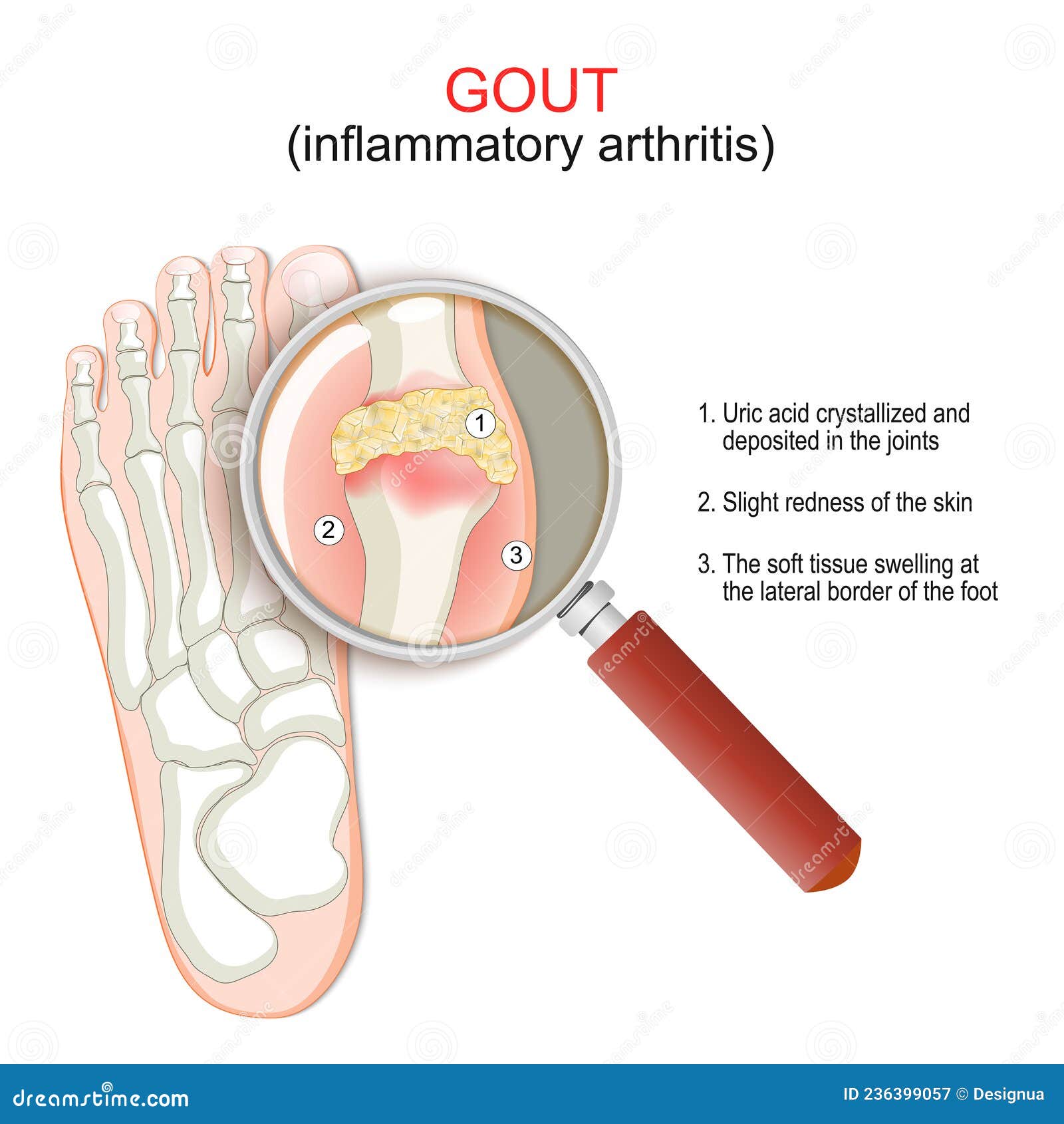 gout. close-up of joint with inflammatory arthritis