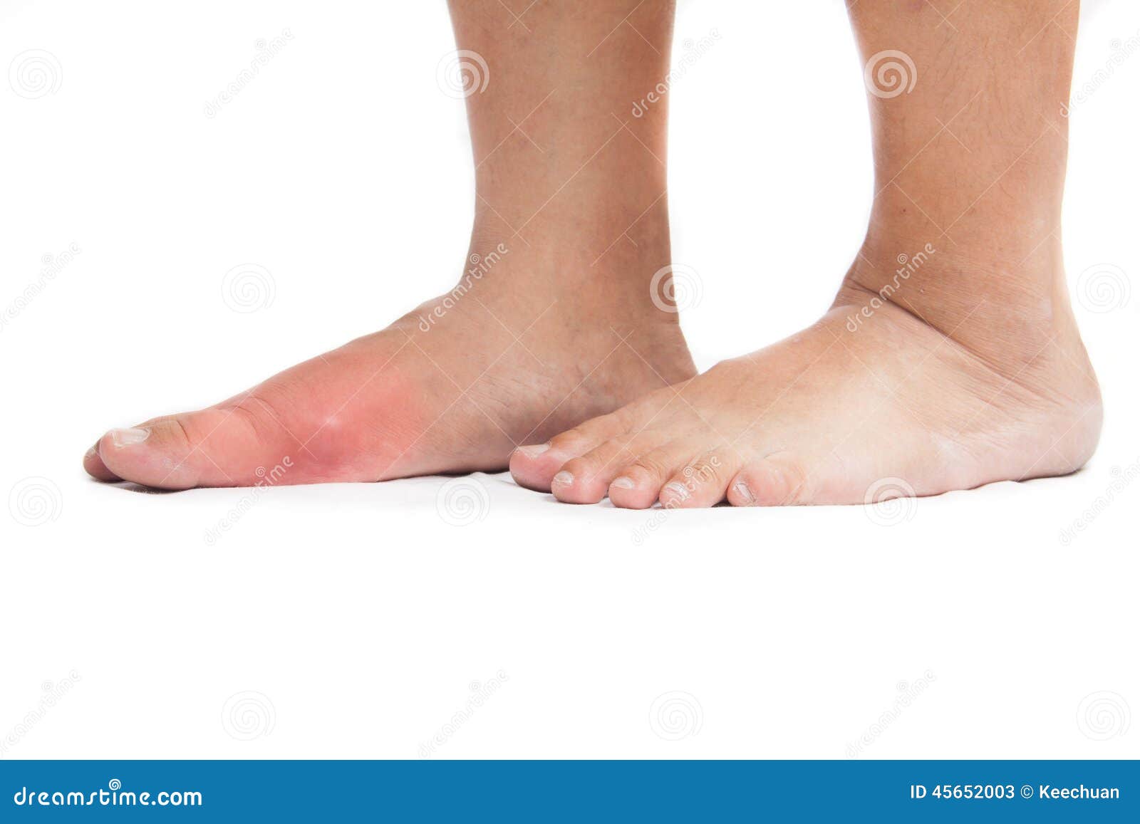 Gout Inflammation on the Right Foot Stock Image Image of body