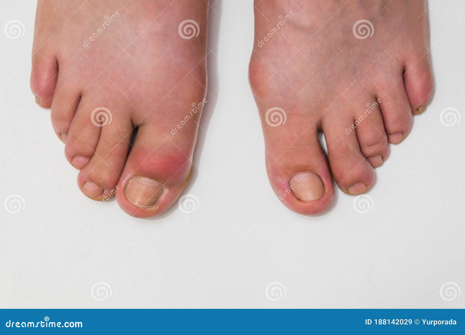 picture Pictures Of Gout In Big Toe dreamstime com