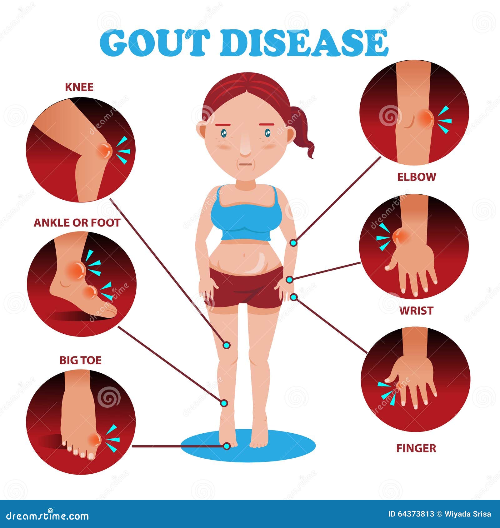 gout symptoms