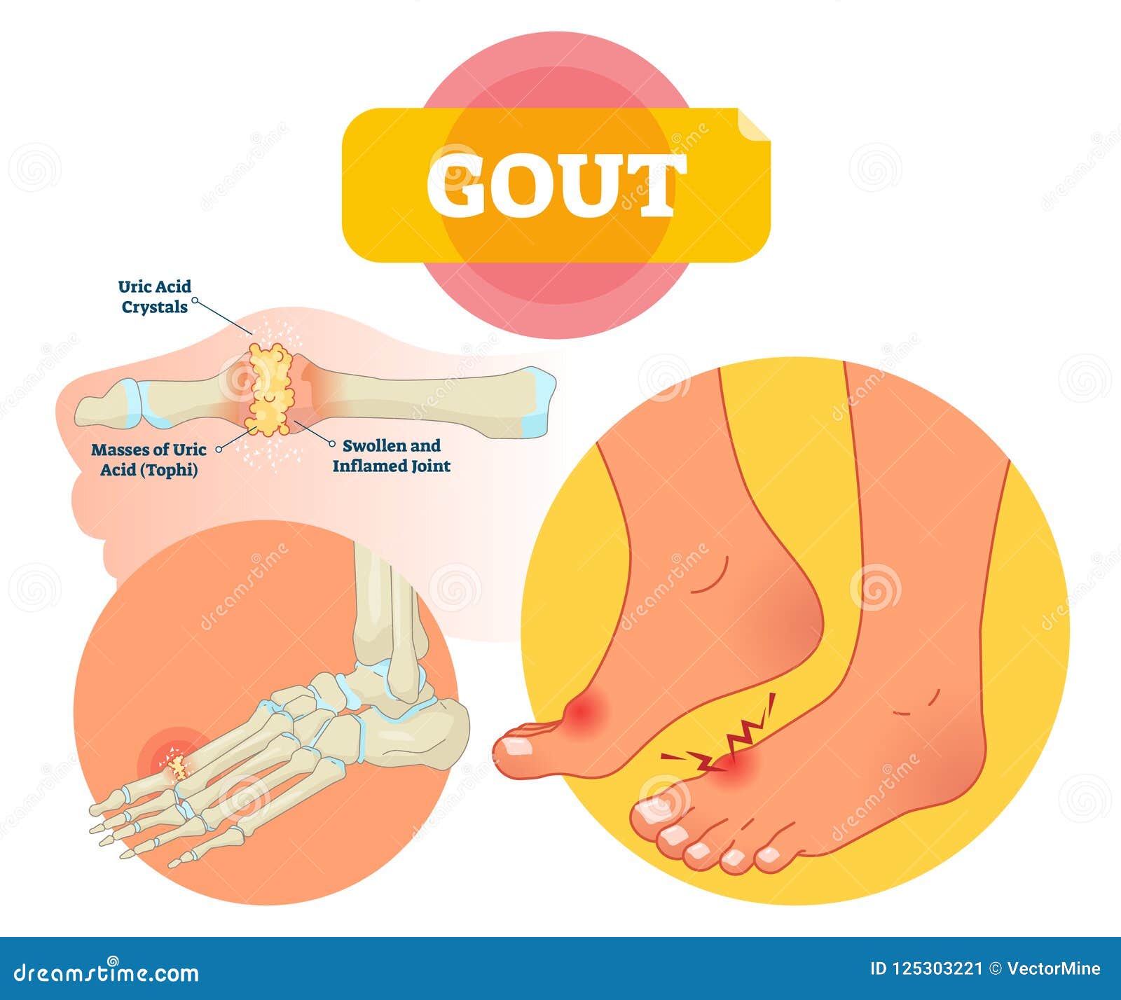 Gout Cartoons, Illustrations &amp; Vector Stock Images - 484 ...