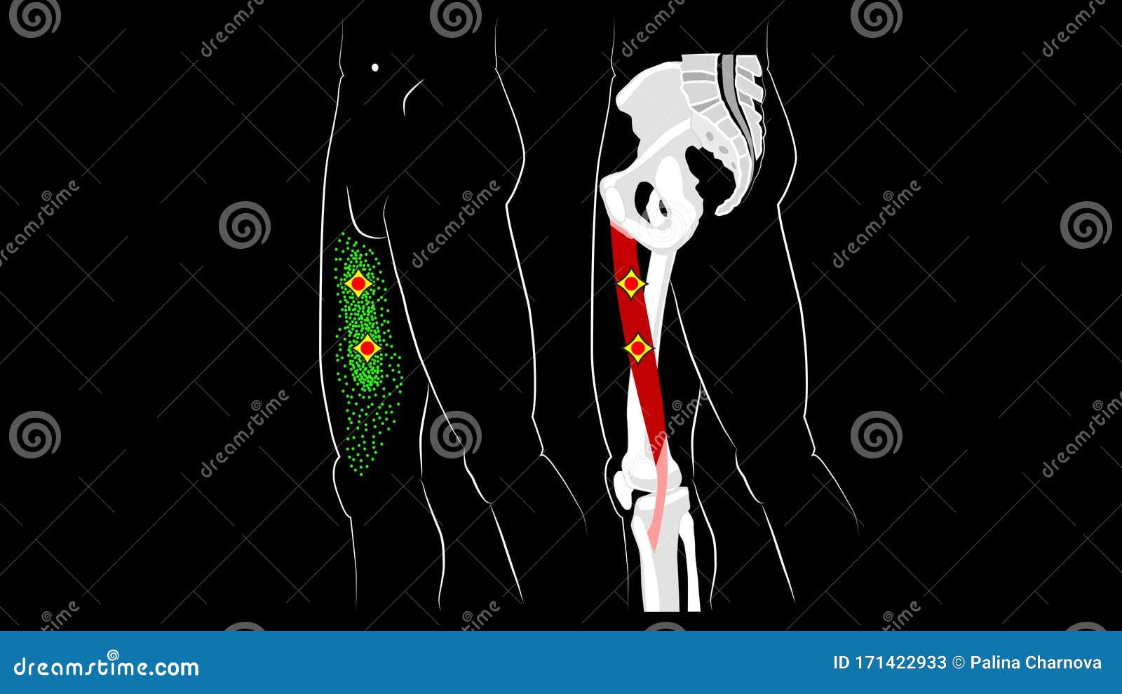 gracilis muscle. structure, trigger points, and reflected pain in the thigh muscle